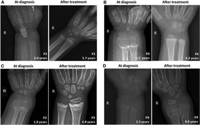 Clinical characteristics and long-term outcomes of 12 children with vitamin D-dependent rickets type 1A: A retrospective study